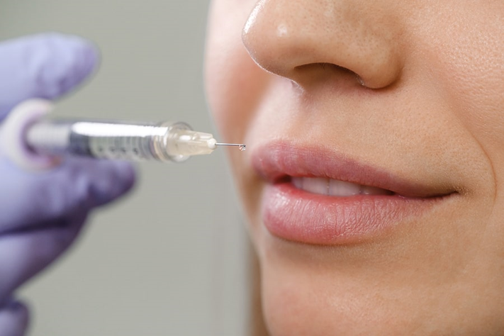 Dermal fillers injected to a woman’s lips for anti-aging treatment